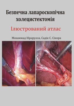 Безопасная лапароскопическая холецистэктомия. Иллюстрированный атлас Мохаммад Ибрарулла 2022г. 6784324 фото