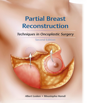 Partial Breast Reconstruction. Techniques in Oncoplastic Surgery Second Edition (Часткова реконструкція молочної залози. Методи в онкопластичній хірургії) 900204 фото