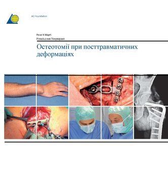 Остеотомії при постравматичних деформаціях Рене К. Марті, Рональд Й. ван Хеерваарден (АО) 799722 фото
