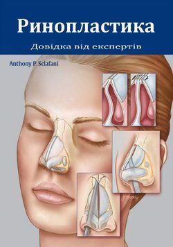 Ринопластика. Довідка для експертів Ентоні П. Склафані 9536014 фото